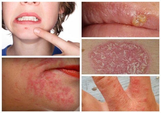 过敏和皮肤病是体内寄生虫的迹象