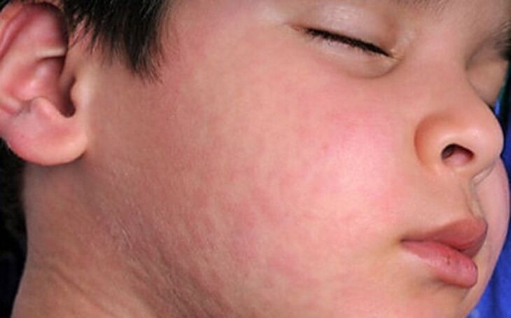 皮肤上的过敏性皮疹 - 体内存在寄生虫的症状